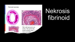 Nekrosis
fibrinoid