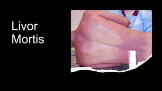 Livor
Mortis