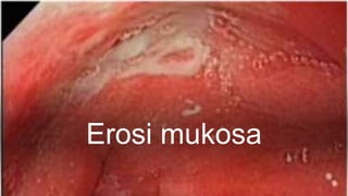 Erosi mukosa