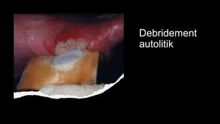 Debridement
autolitik