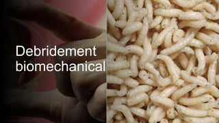 Debridement
biomechanical