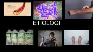 ETIOLOGI