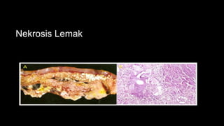 Nekrosis Lemak