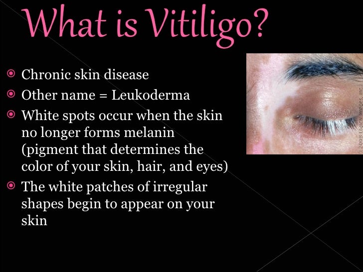 Kena Leen Cream And Vitiligo