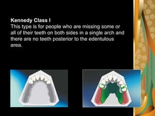 Rule 8: there can be no modification
areas in class IV. Because any
additional edentulous space will
definitely be posteri...