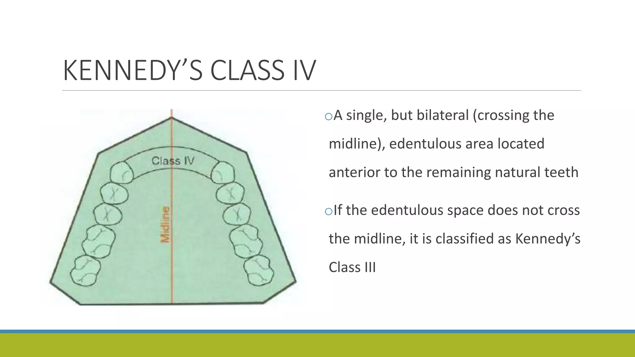 KENNEDY’S CLASS IV
oA single, but bilateral (crossing the
midline), edentulous area located
anterior to the remaining natural teeth
oIf the edentulous space does not cross
the midline, it is classified as Kennedy’s
Class III
 
