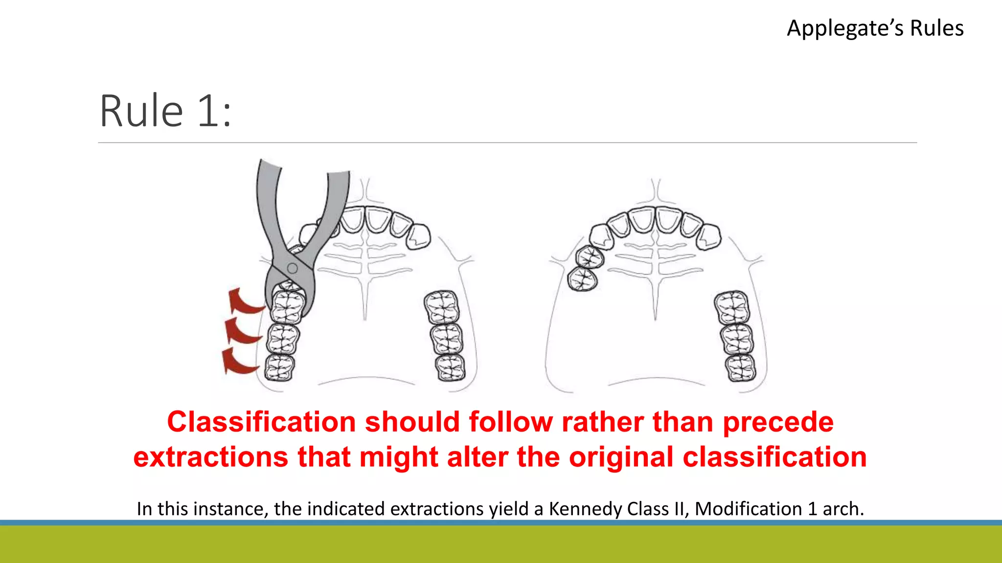 Rule 1:
Applegate’s Rules
Classification should follow rather than precede
extractions that might alter the original classification
In this instance, the indicated extractions yield a Kennedy Class II, Modification 1 arch.
 