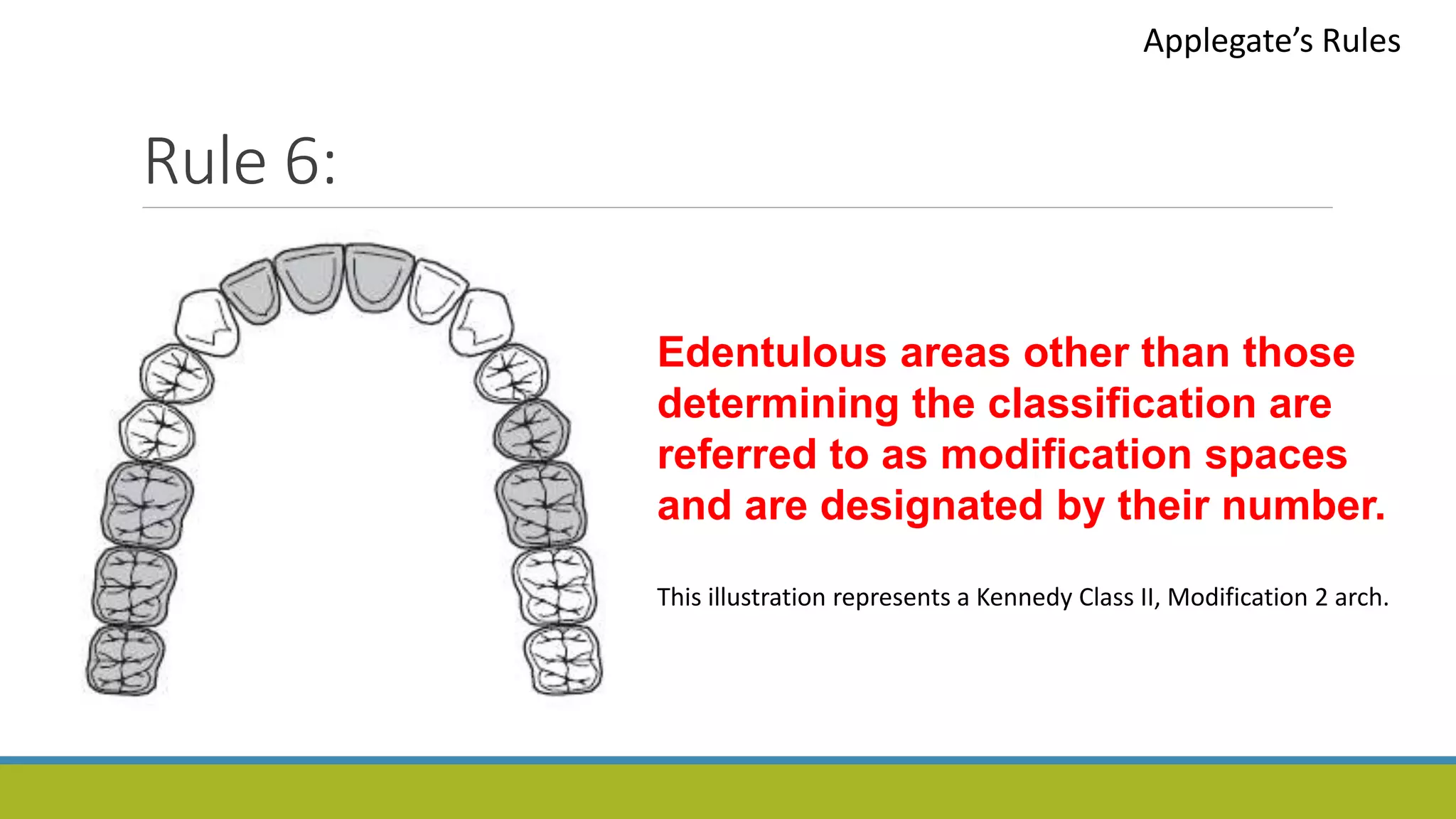 Rule 6:
Applegate’s Rules
Edentulous areas other than those
determining the classification are
referred to as modification spaces
and are designated by their number.
This illustration represents a Kennedy Class II, Modification 2 arch.
 