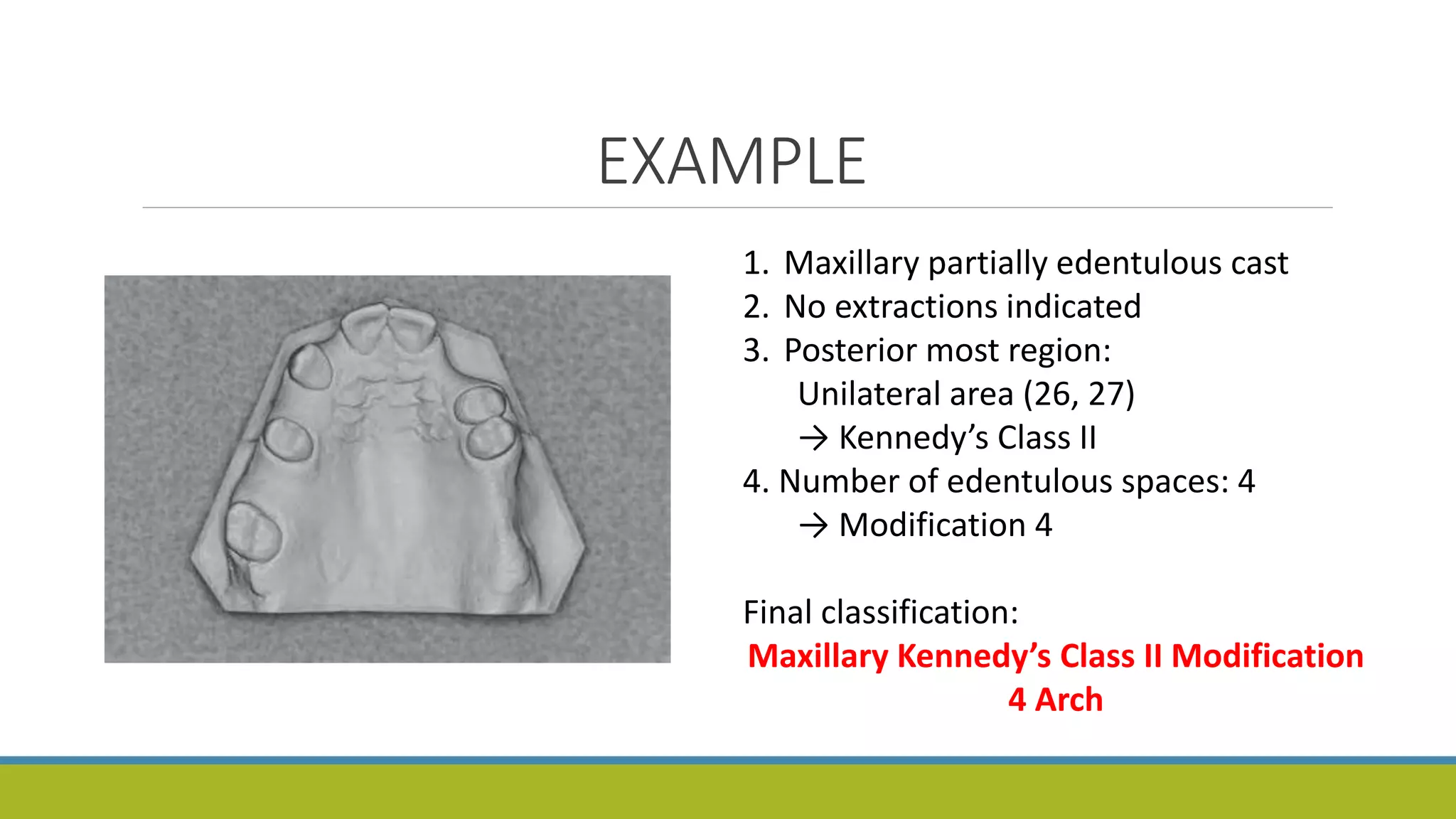 EXAMPLE
1. Maxillary partially edentulous cast
2. No extractions indicated
3. Posterior most region:
Unilateral area (26, 27)
→ Kennedy’s Class II
4. Number of edentulous spaces: 4
→ Modification 4
Final classification:
Maxillary Kennedy’s Class II Modification
4 Arch
 