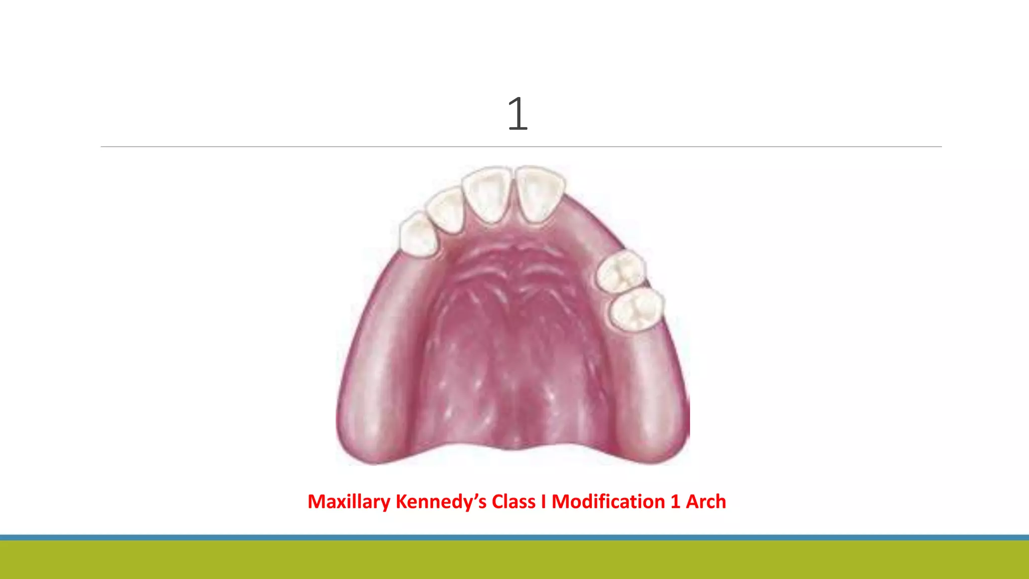 1
Maxillary Kennedy’s Class I Modification 1 Arch
 