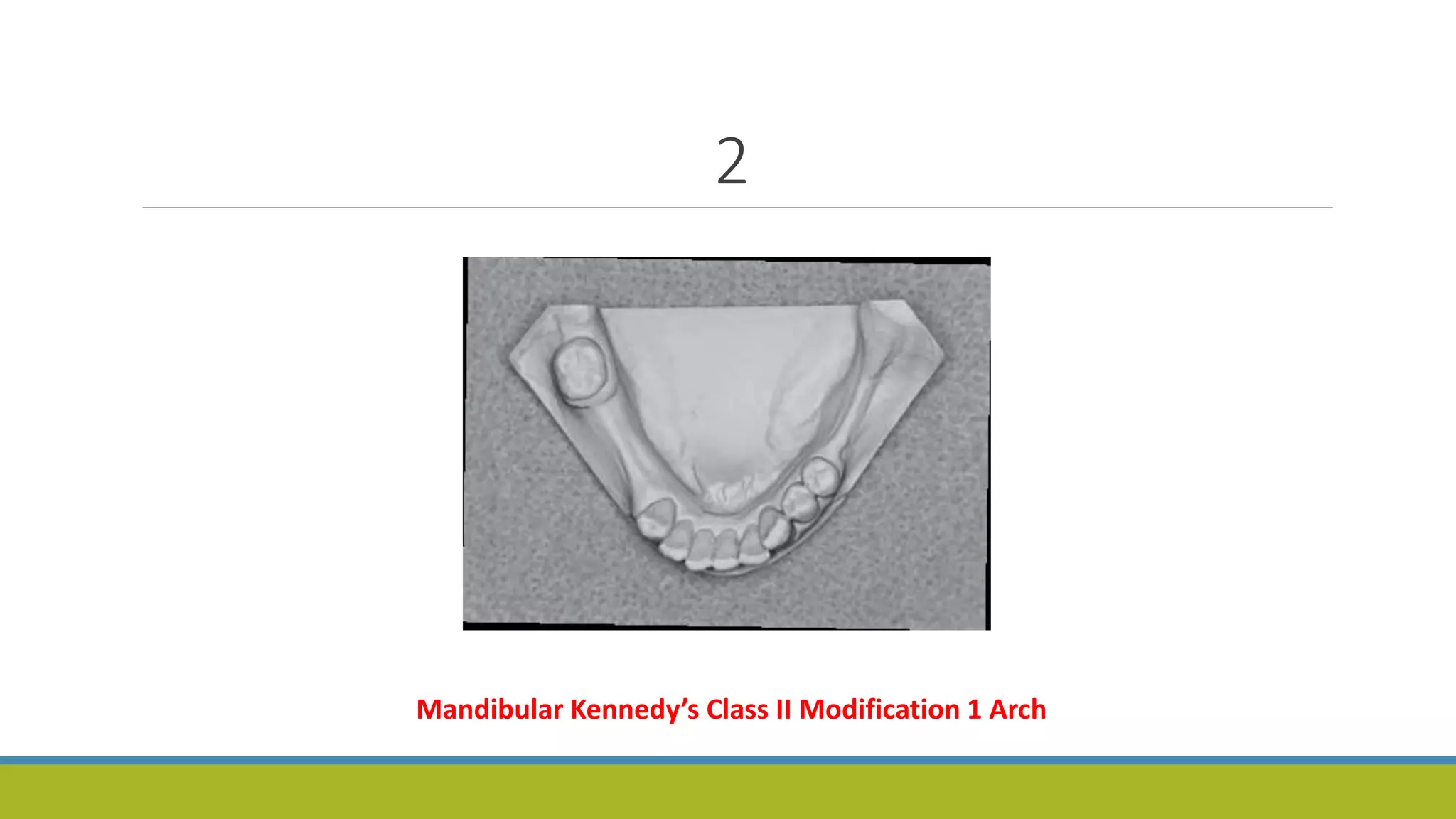 2
Mandibular Kennedy’s Class II Modification 1 Arch
 