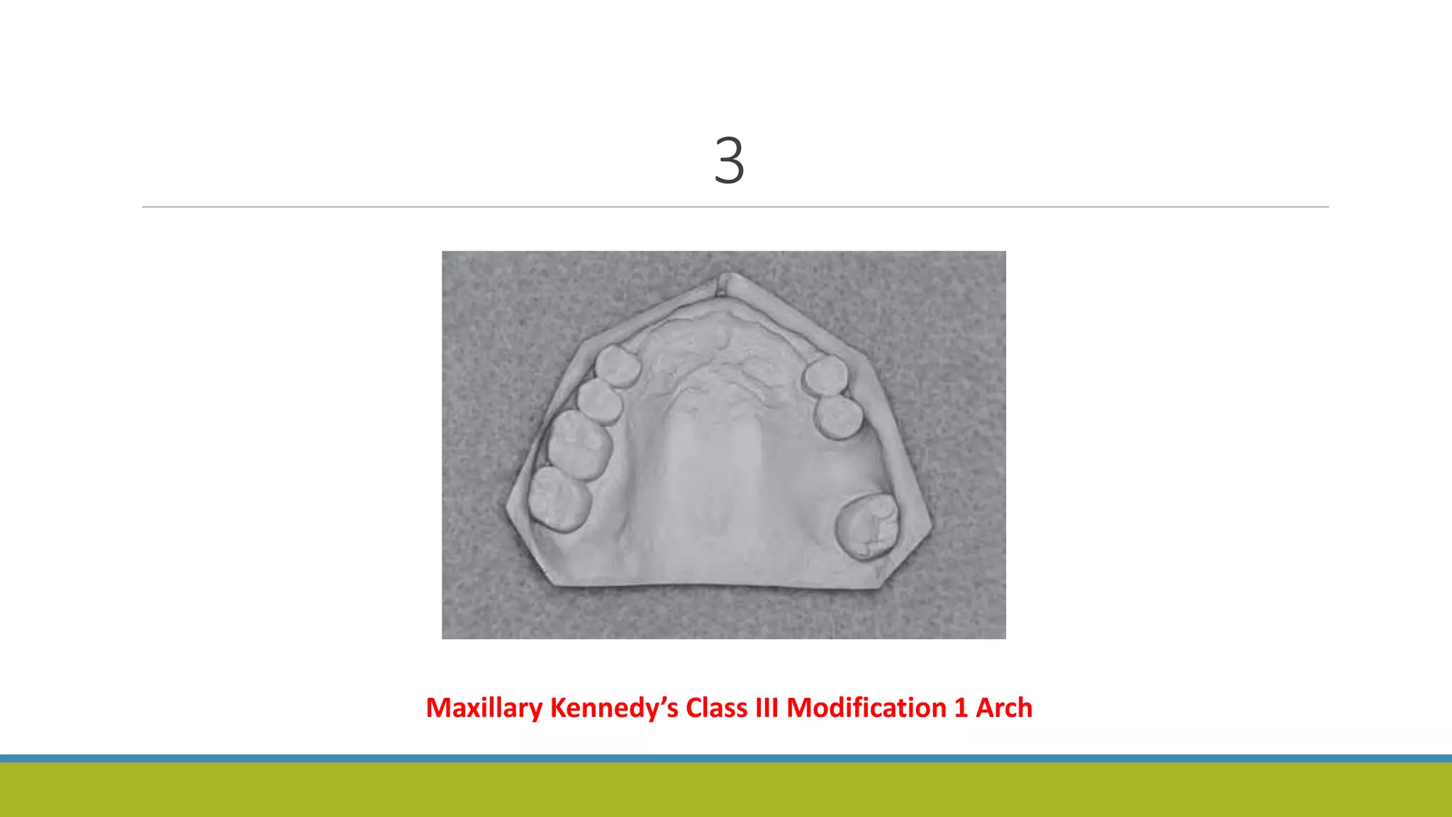3
Maxillary Kennedy’s Class III Modification 1 Arch
 