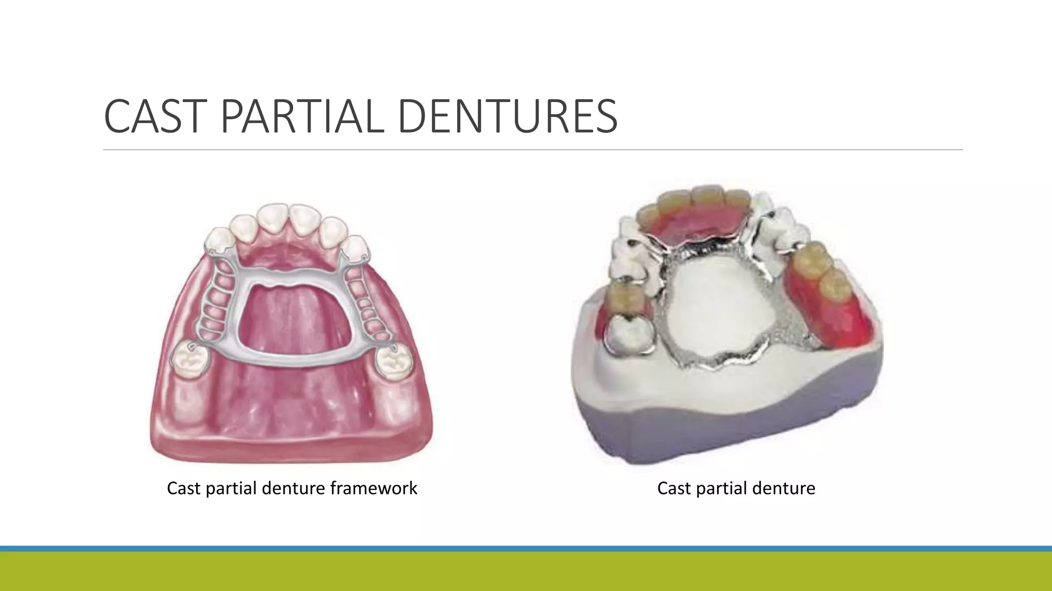 CAST PARTIAL DENTURES
Cast partial denture framework Cast partial denture
 