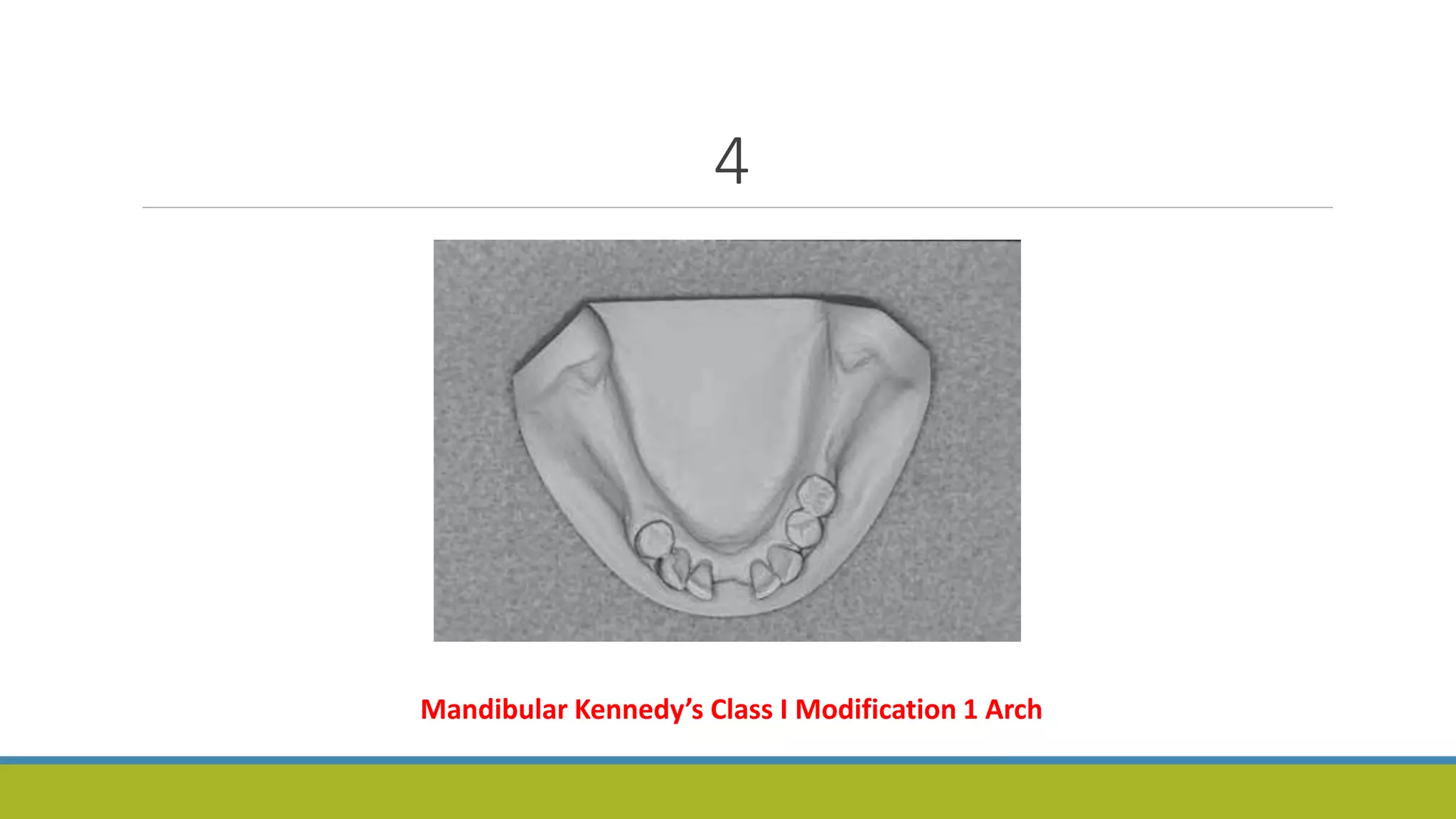 4
Mandibular Kennedy’s Class I Modification 1 Arch
 