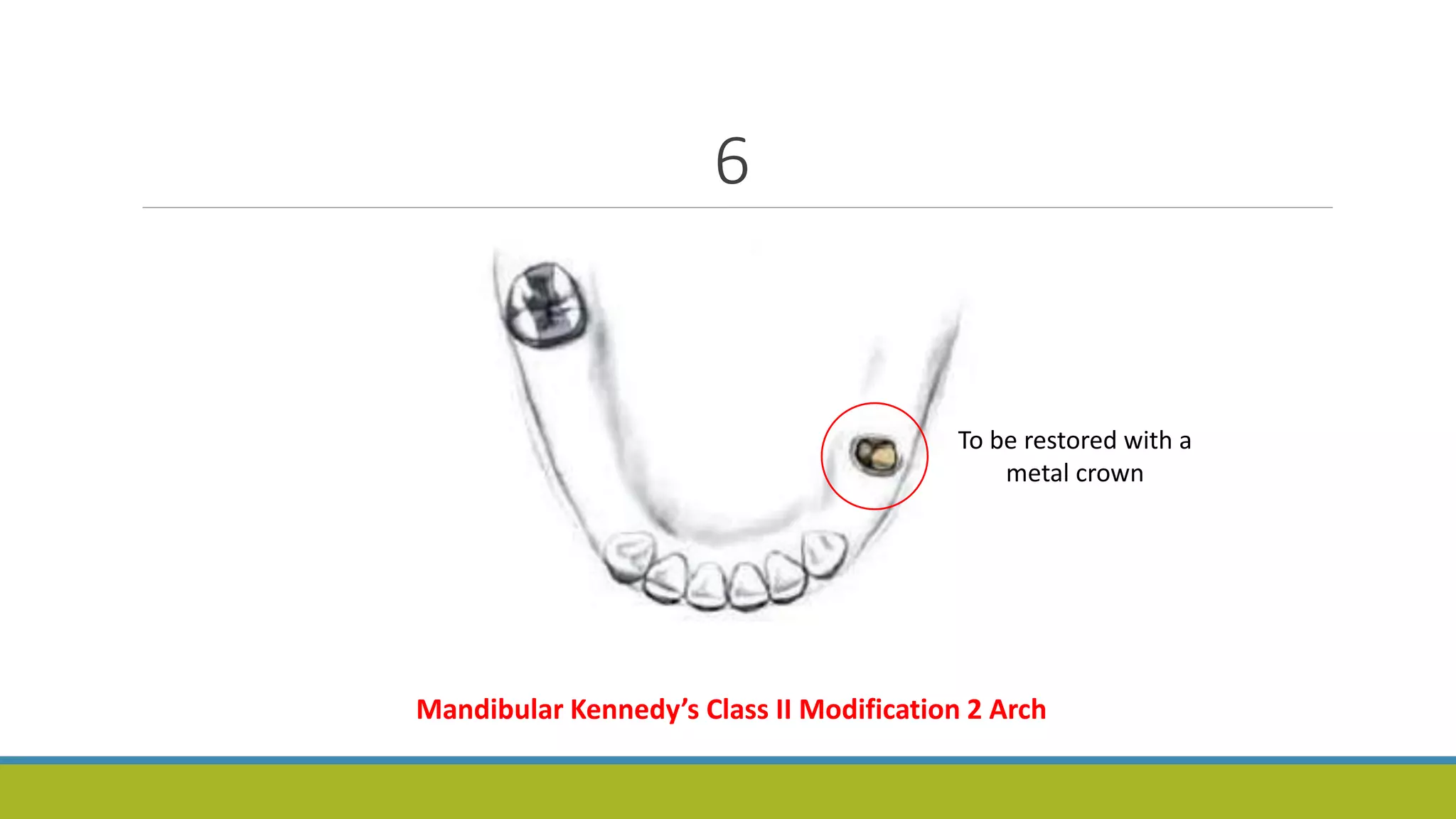 6
To be restored with a
metal crown
Mandibular Kennedy’s Class II Modification 2 Arch
 