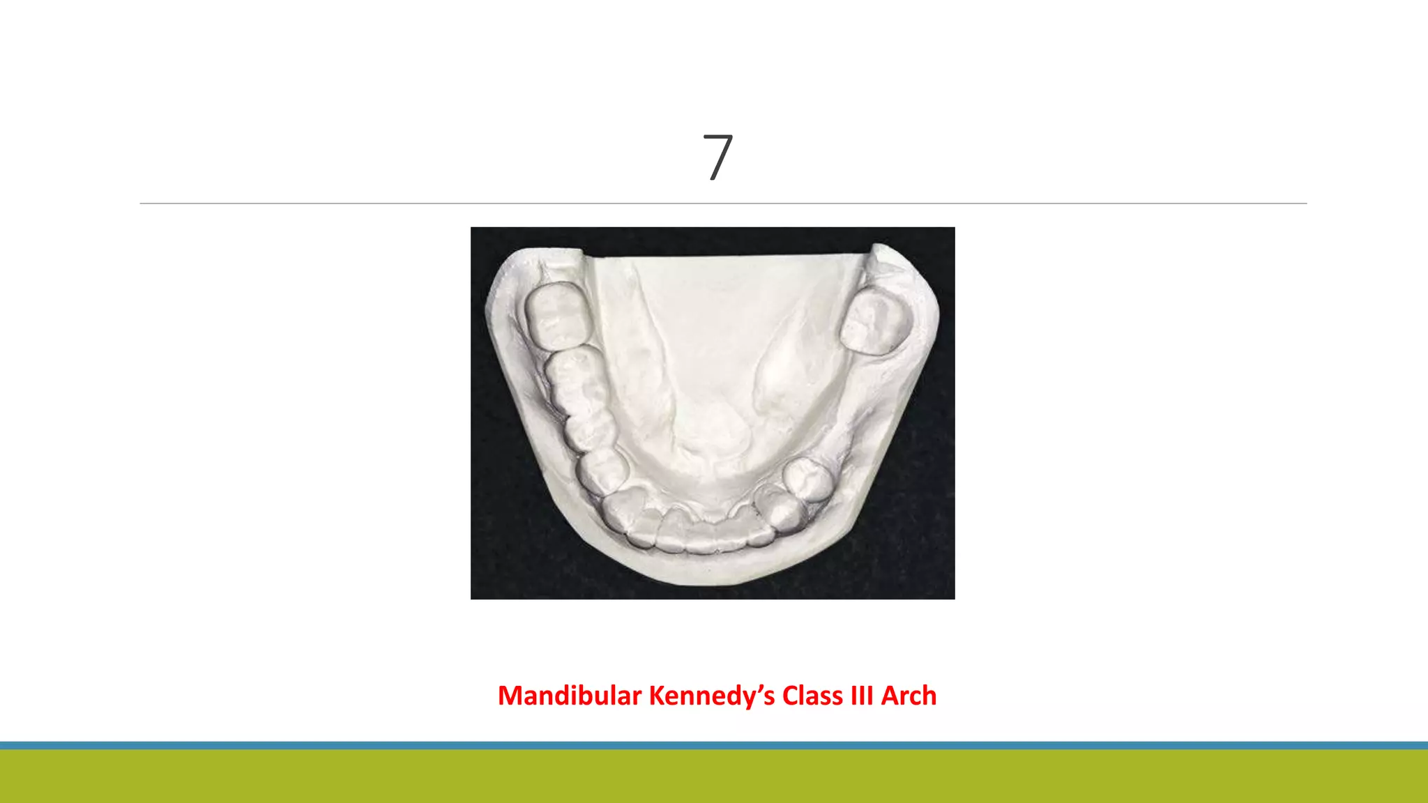 7
Mandibular Kennedy’s Class III Arch
 