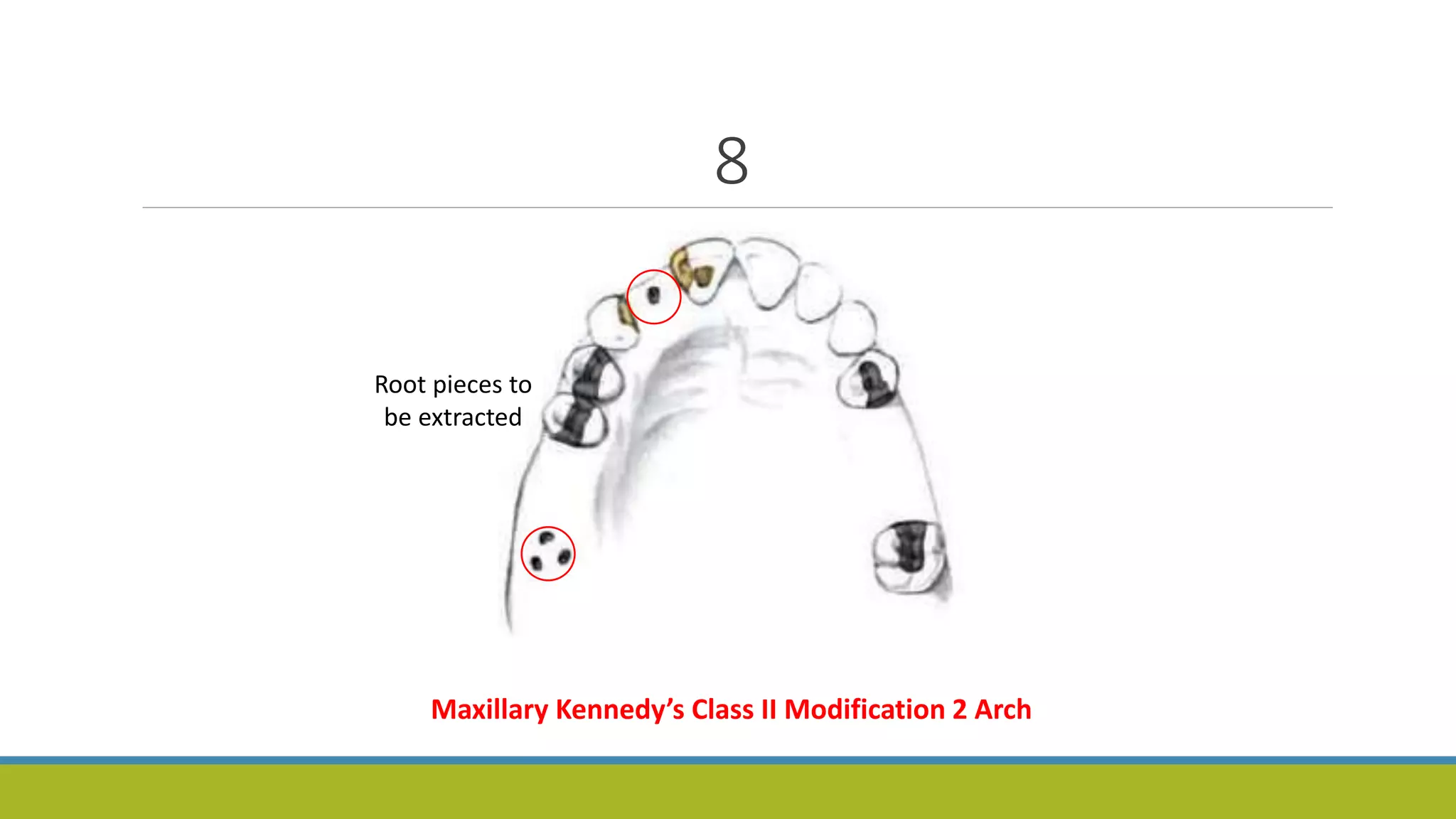 8
Root pieces to
be extracted
Maxillary Kennedy’s Class II Modification 2 Arch
 