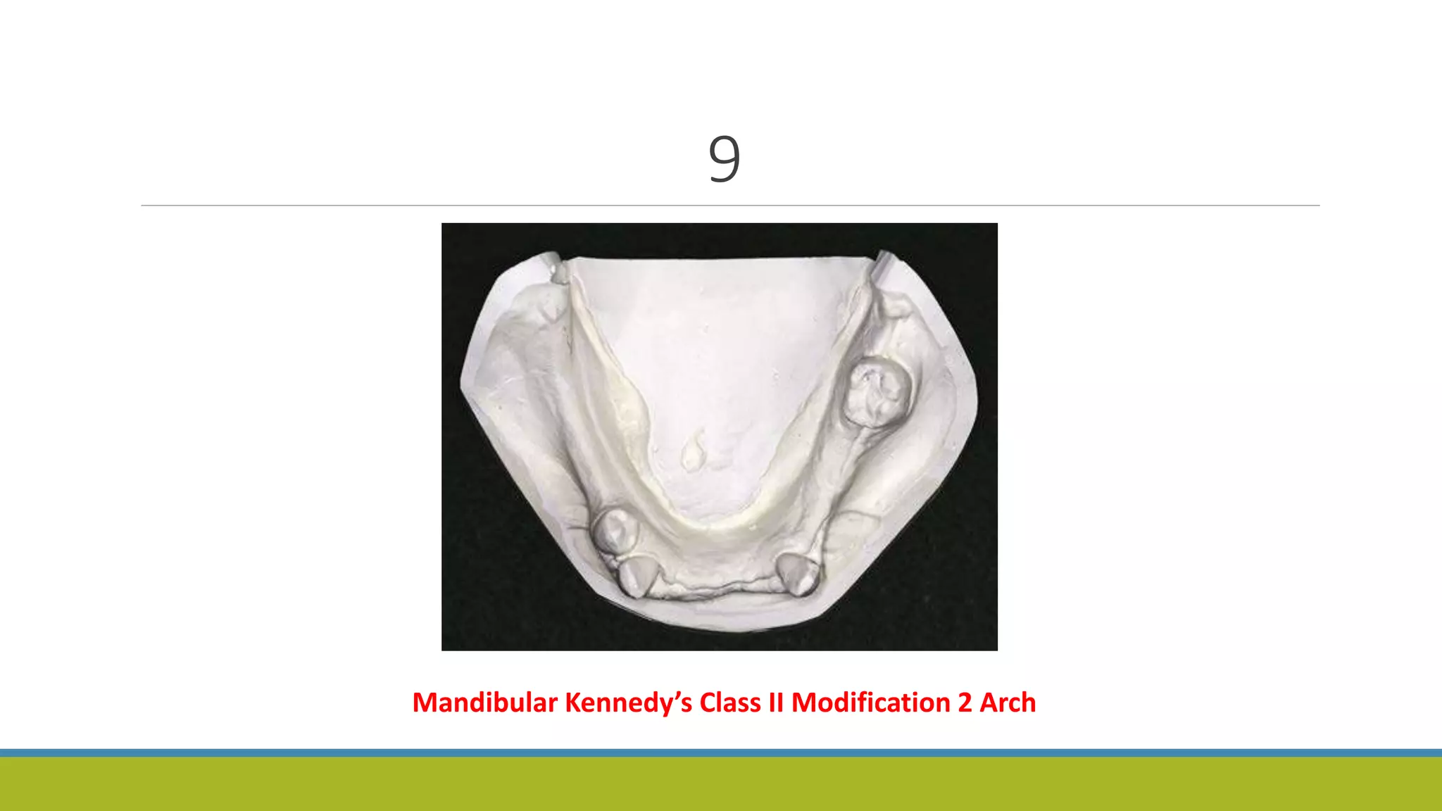 9
Mandibular Kennedy’s Class II Modification 2 Arch
 