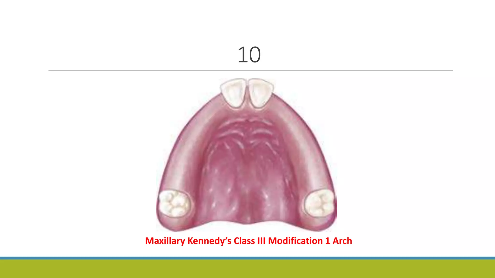 10
Maxillary Kennedy’s Class III Modification 1 Arch
 