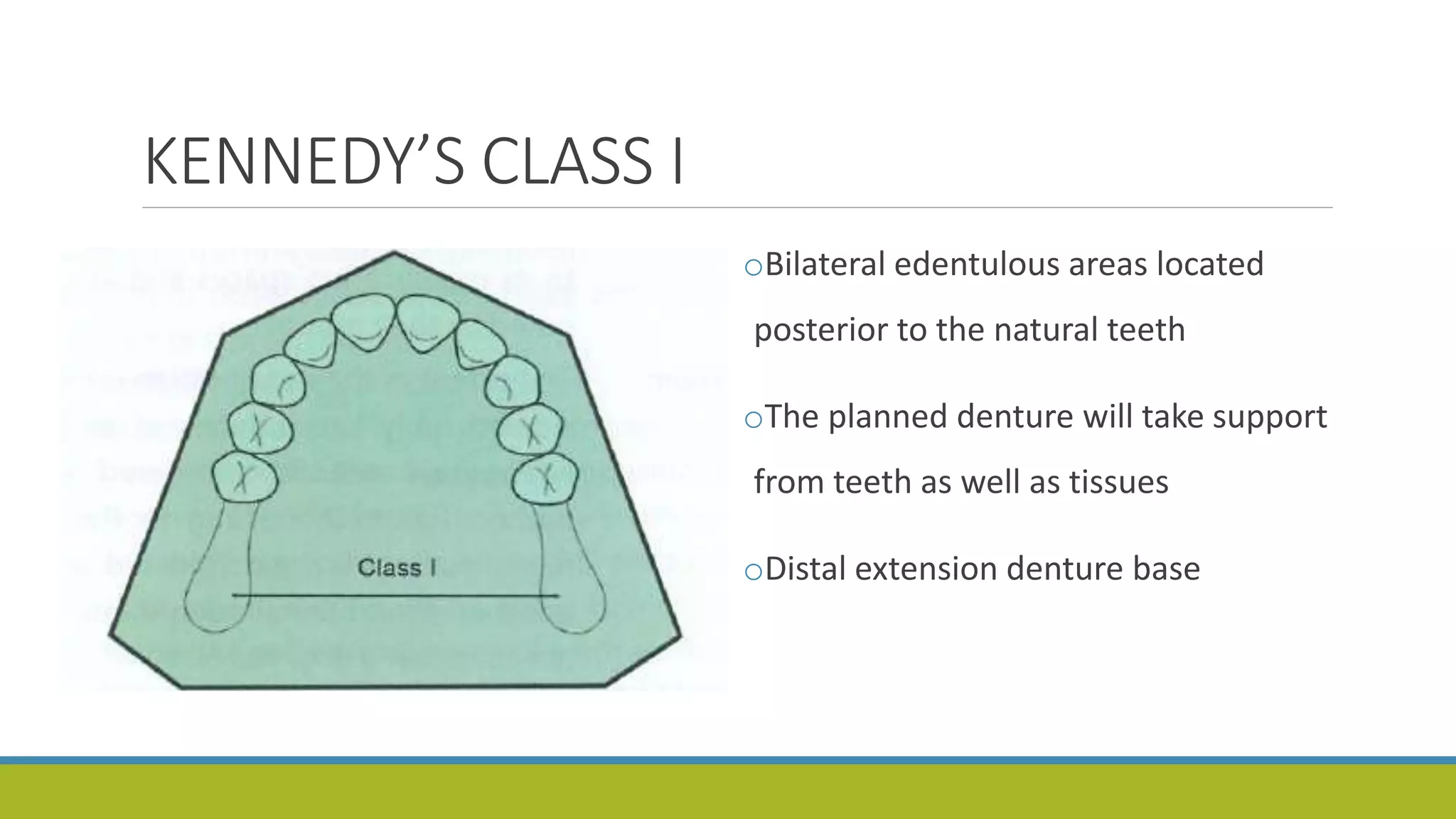 KENNEDY’S CLASS I
oBilateral edentulous areas located
posterior to the natural teeth
oThe planned denture will take support
from teeth as well as tissues
oDistal extension denture base
 