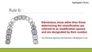 Rule 6:
Applegate’s Rules
Edentulous areas other than those
determining the classification are
referred to as modification spaces
and are designated by their number.
This illustration represents a Kennedy Class II, Modification 2 arch.
 
