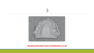 3
Maxillary Kennedy’s Class III Modification 1 Arch
 