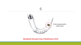 6
To be restored with a
metal crown
Mandibular Kennedy’s Class II Modification 2 Arch
 