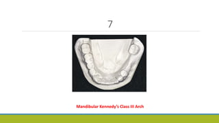 7
Mandibular Kennedy’s Class III Arch
 