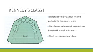 KENNEDY’S CLASS I
oBilateral edentulous areas located
posterior to the natural teeth
oThe planned denture will take support
from teeth as well as tissues
oDistal extension denture base
 