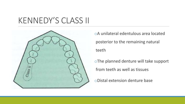 Kennedy’s Classification in Cast Partial Denture | PPTX | Dental Health ...