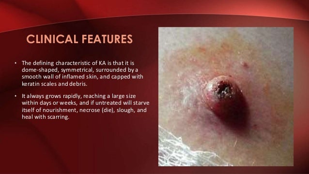 Keraoacanthoma