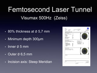 • 80% thickness at ∅ 5,7 mm
• Minimum depth 300µm
• Inner ∅ 5 mm
• Outer ∅ 6,5 mm
• Incision axis: Steep Meridian
Femtosecond Laser Tunnel
Visumax 500Hz (Zeiss)
 