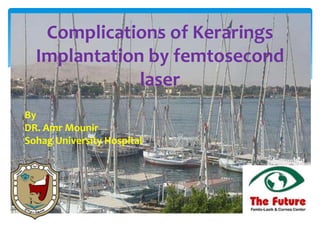 Complications of Kerarings
Implantation by femtosecond
laser
By
DR. Amr Mounir
Sohag University Hospital
 