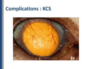Complications : KCS
 