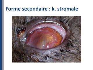 Forme secondaire : k. stromale
 