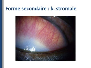 Forme secondaire : k. stromale
 