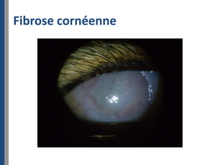 Fibrose cornéenne
 