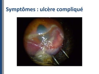Symptômes : ulcère compliqué
 
