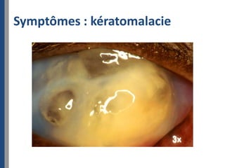 Symptômes : kératomalacie
 