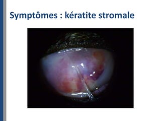 Symptômes : kératite stromale
 