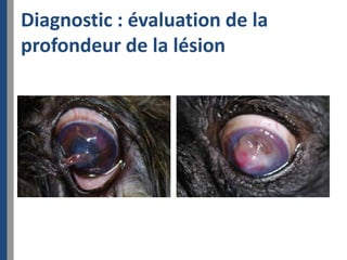 Diagnostic : évaluation de la
profondeur de la lésion
 