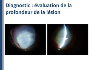 Diagnostic : évaluation de la
profondeur de la lésion
 