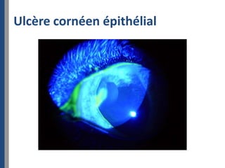 Ulcère cornéen épithélial
 