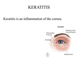 KERATITIS
Keratitis is an inflammation of the cornea.
 