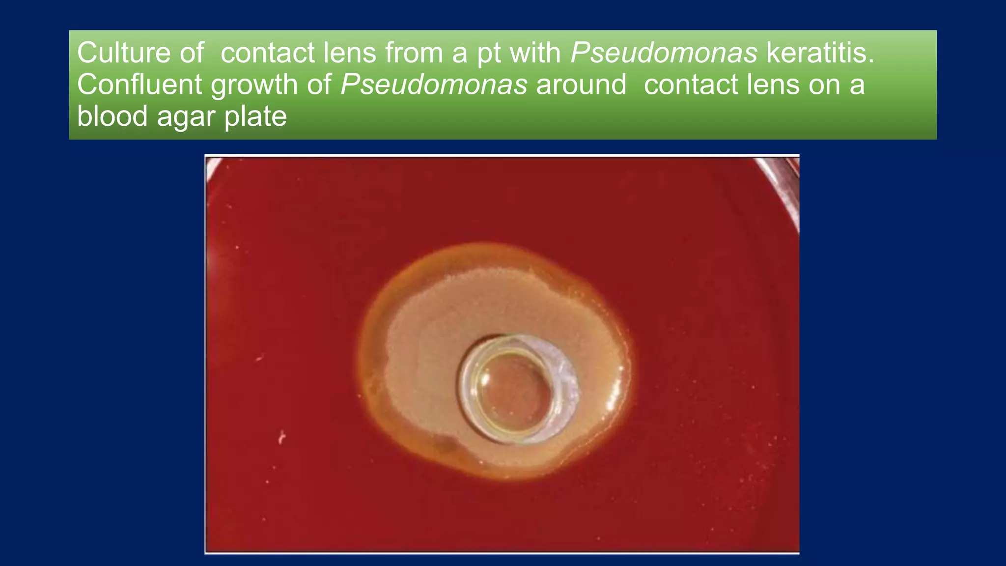 Culture of contact lens from a pt with Pseudomonas keratitis.
Confluent growth of Pseudomonas around contact lens on a
blood agar plate
 