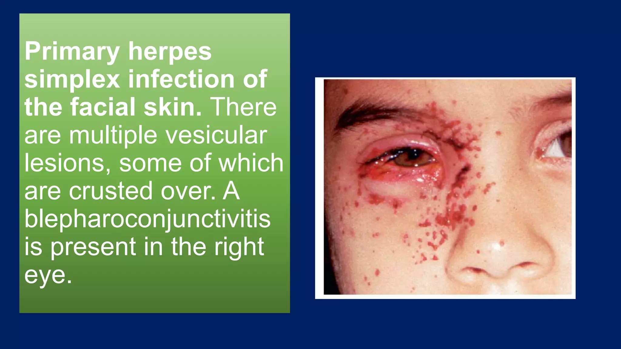 Primary herpes
simplex infection of
the facial skin. There
are multiple vesicular
lesions, some of which
are crusted over. A
blepharoconjunctivitis
is present in the right
eye.
 
