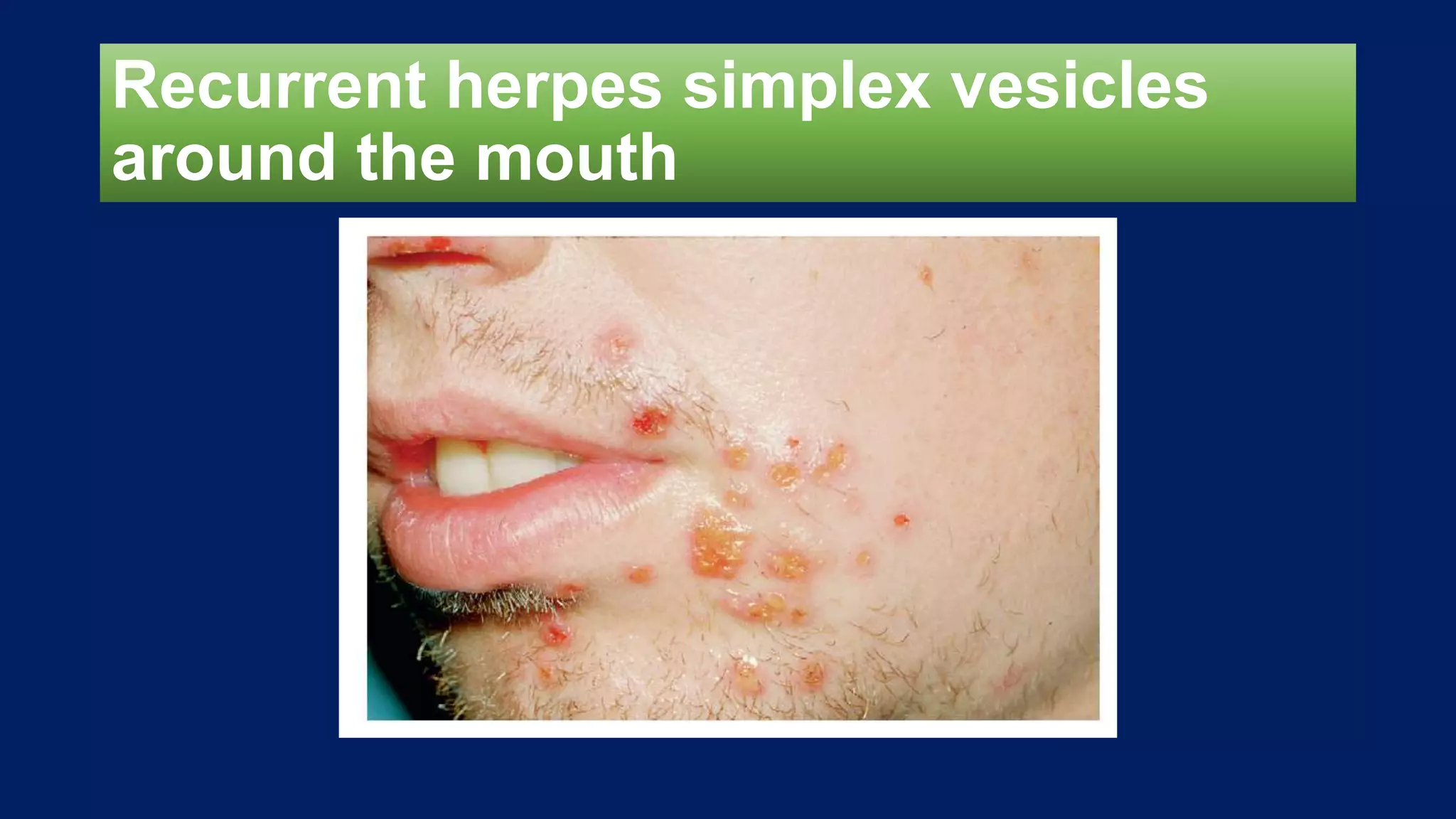 Recurrent herpes simplex vesicles
around the mouth
 