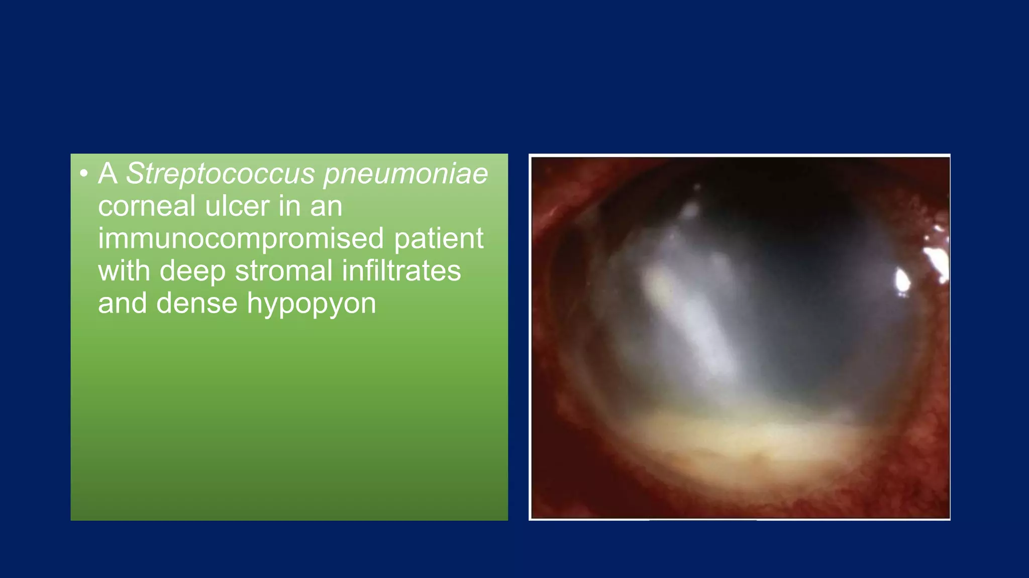 • A Streptococcus pneumoniae
corneal ulcer in an
immunocompromised patient
with deep stromal infiltrates
and dense hypopyon
 