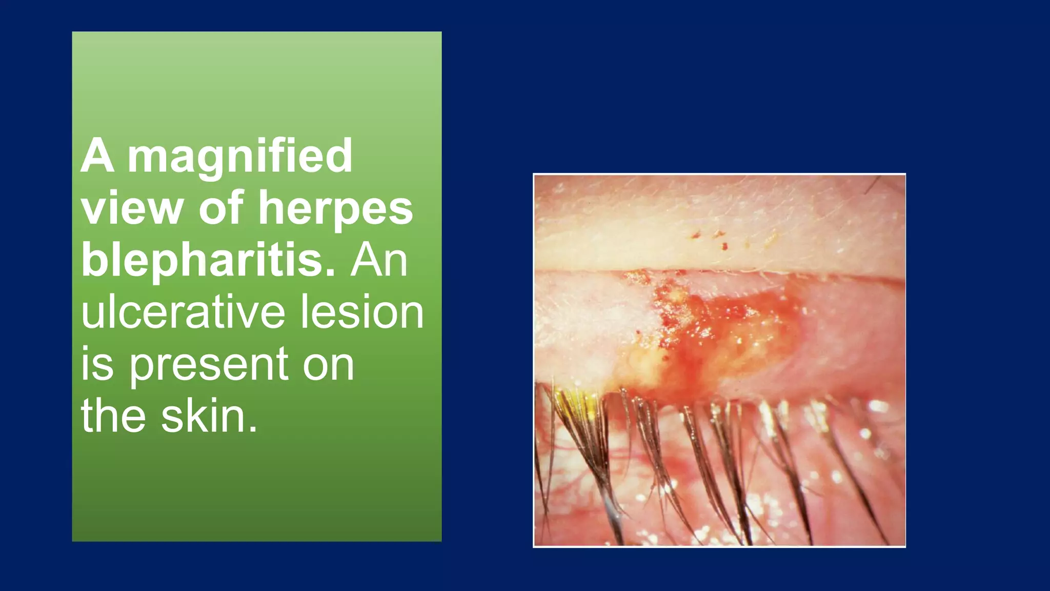 A magnified
view of herpes
blepharitis. An
ulcerative lesion
is present on
the skin.
 