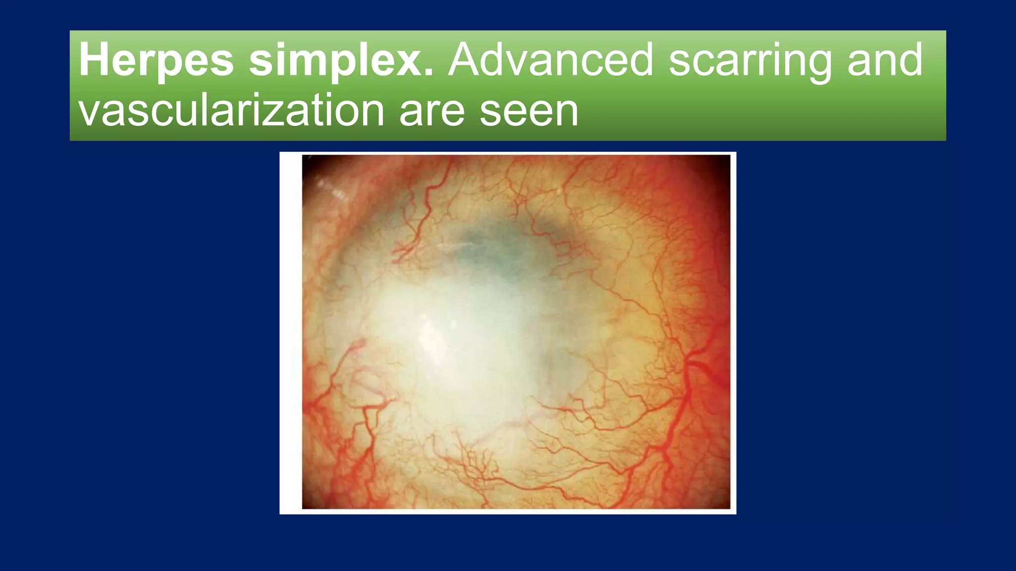 Herpes simplex. Advanced scarring and
vascularization are seen
 